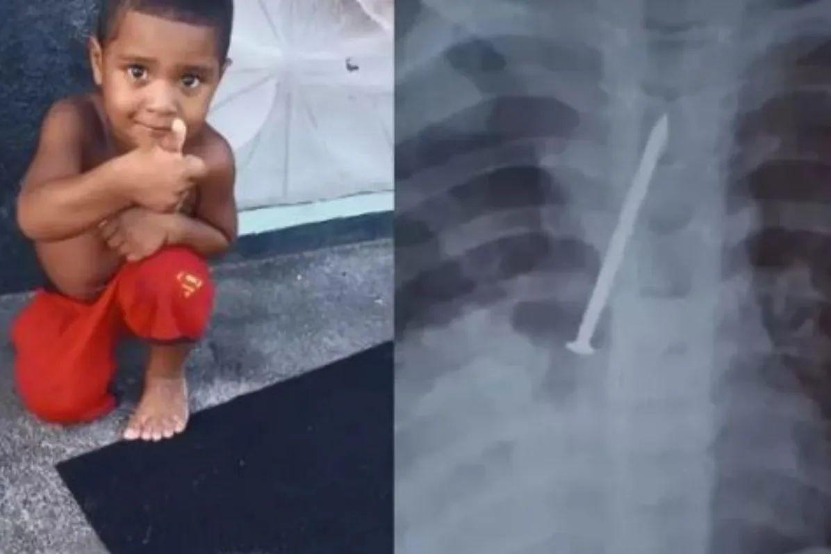 O exame comprovou que a criança engoliu um prego de 10 centímetros