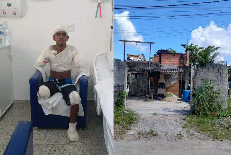 Jovem tem braços, perna e parte do pé amputados após ser eletrocutado em obra de Santos