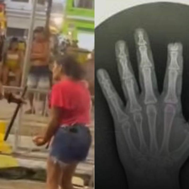 Vítima teve a ponta do dedo indicador direito arrancada; ela registrou um boletim de ocorrência contra o suposto agressor