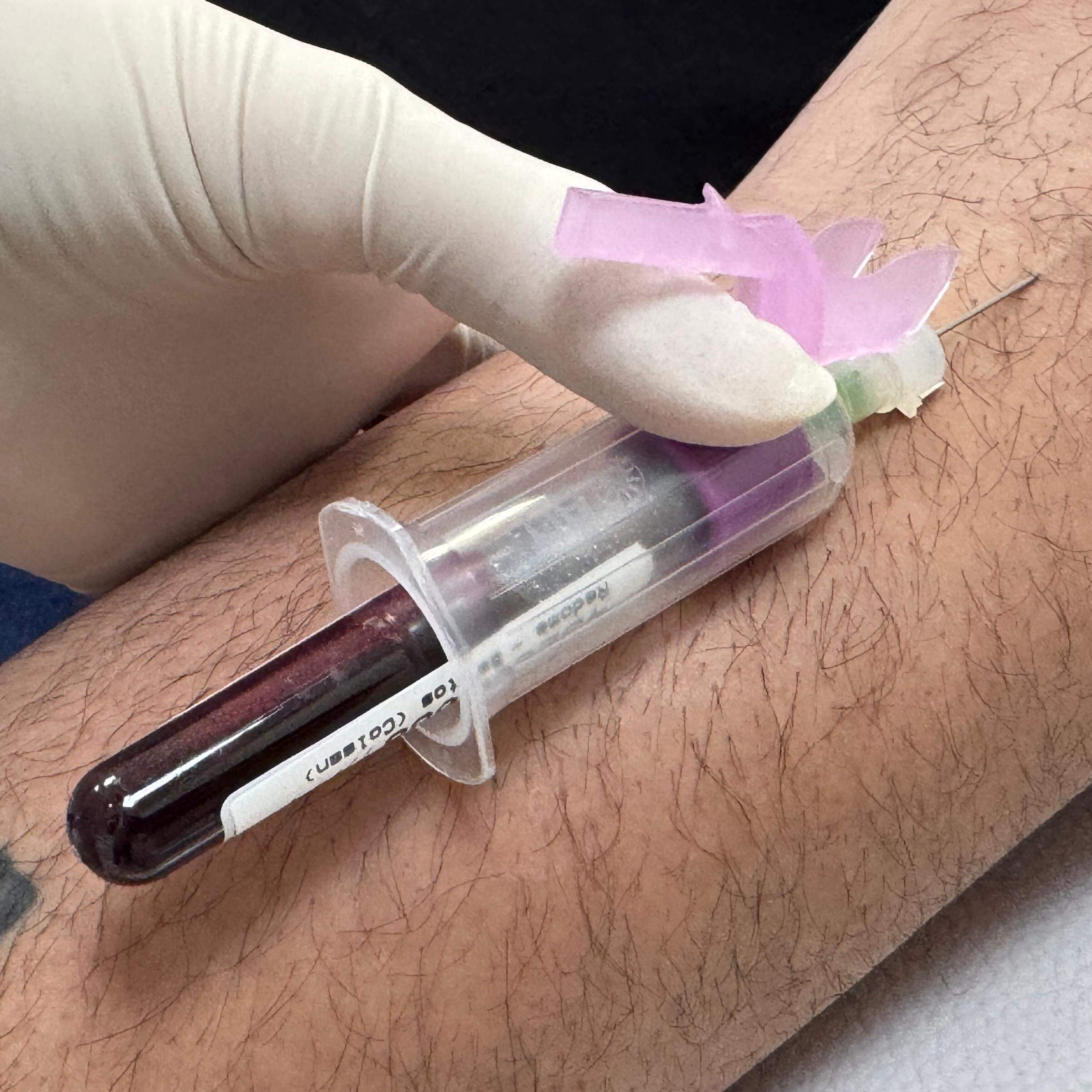 Dos doadores se faz coleta de dez mililitros de sangue e a amostra é enviada ao Registro Nacional de Doadores de Medula Óssea (Redome)