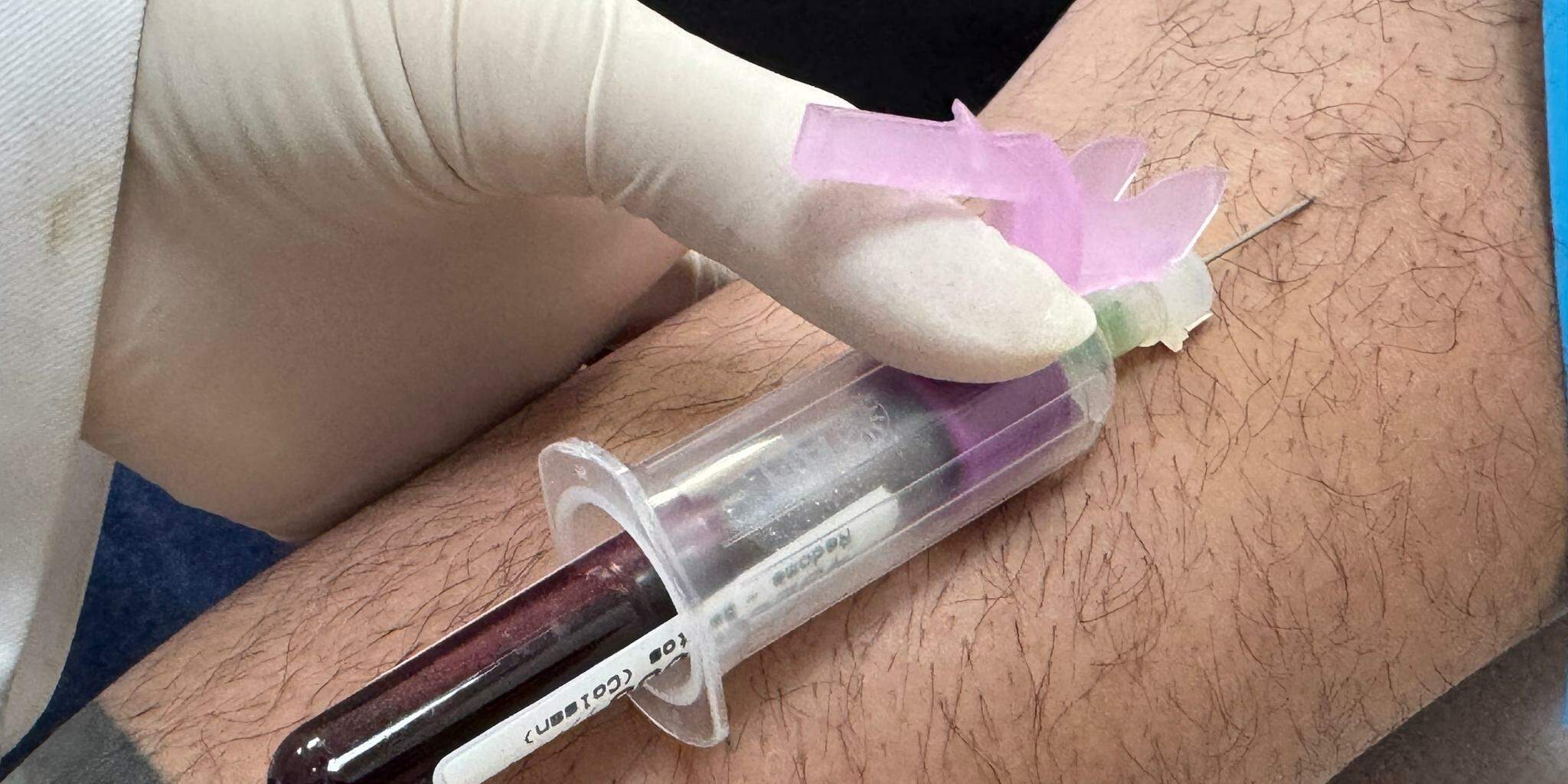 Dos doadores se faz coleta de dez mililitros de sangue e a amostra é enviada ao Registro Nacional de Doadores de Medula Óssea (Redome)