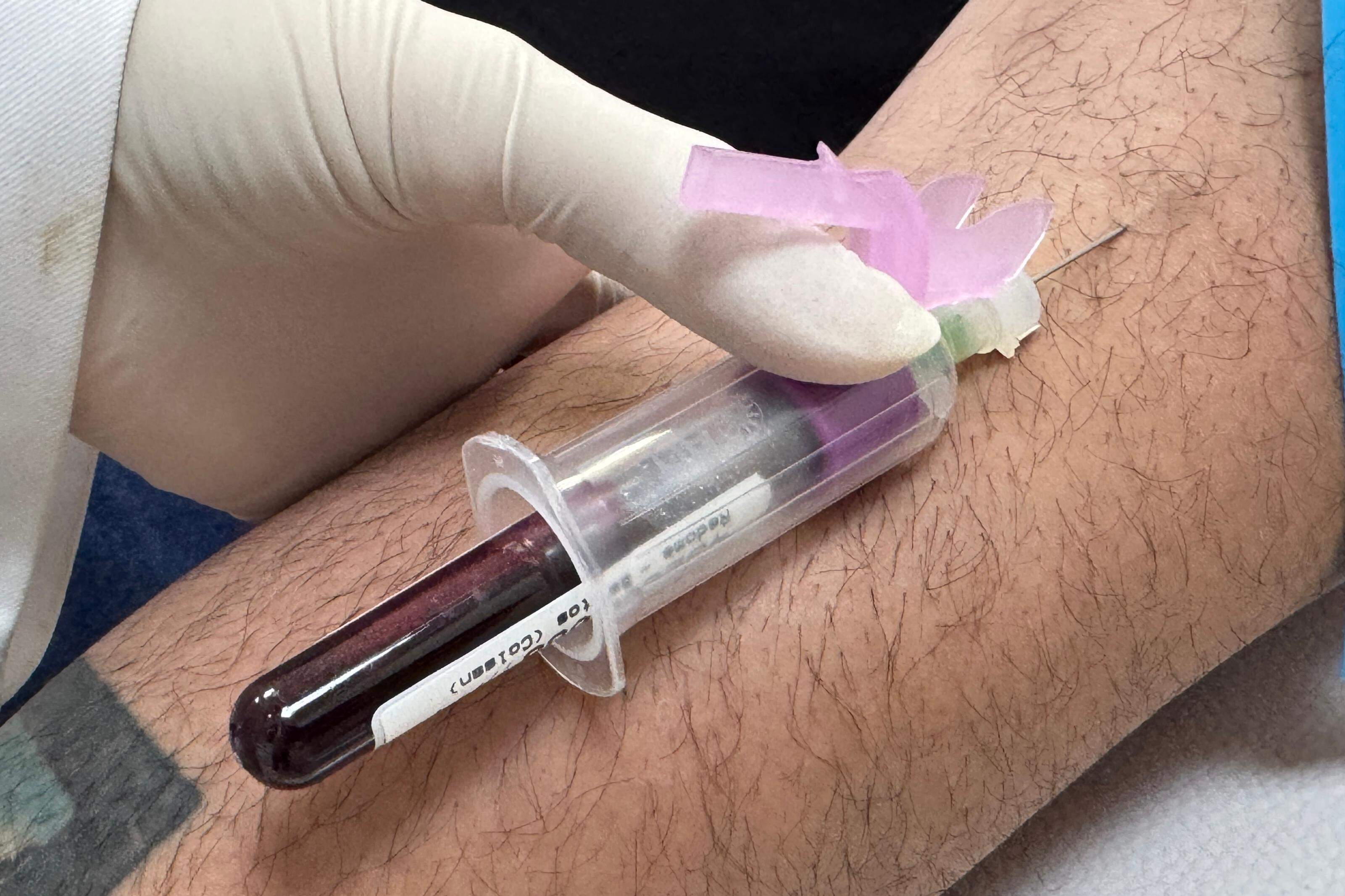 Dos doadores se faz coleta de dez mililitros de sangue e a amostra é enviada ao Registro Nacional de Doadores de Medula Óssea (Redome)