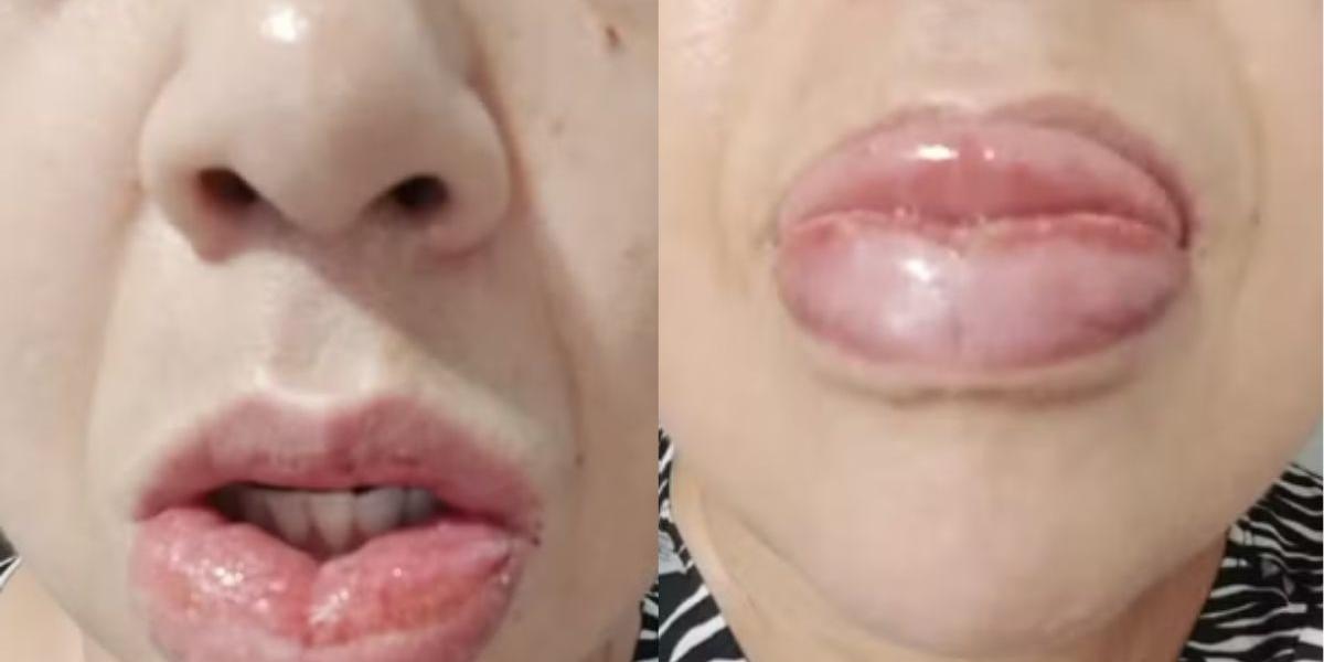 A mulher sofreu com inchaço e vermelhidão nos lábios