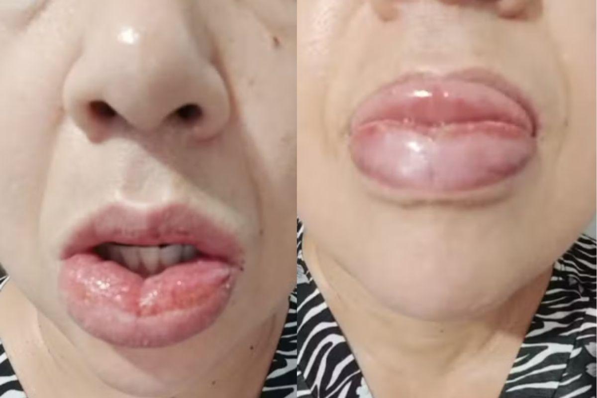 A mulher sofreu com inchaço e vermelhidão nos lábios