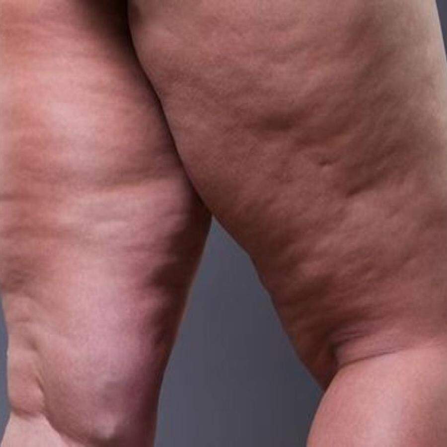 O lipedema não está necessariamente relacionado ao excesso de peso, e pode afetar até mulheres magras
