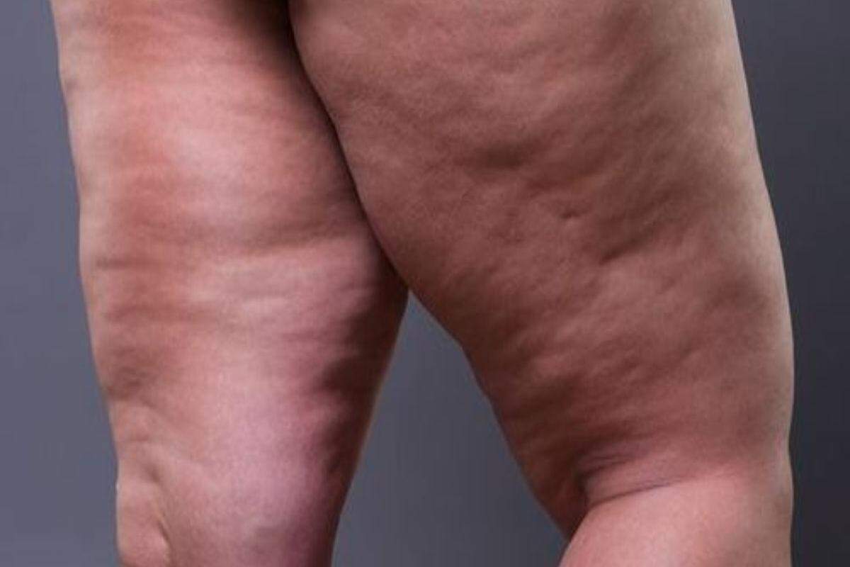 O lipedema não está necessariamente relacionado ao excesso de peso, e pode afetar até mulheres magras