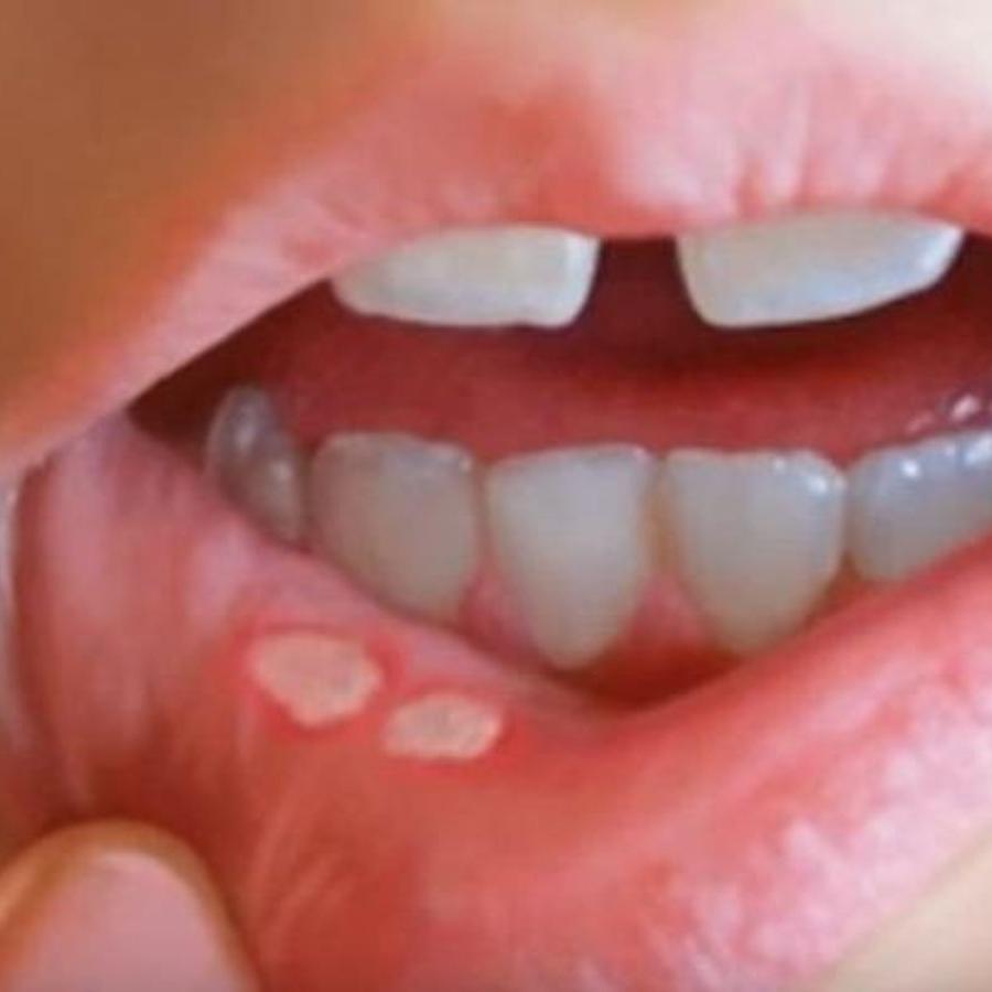 O uso de sal ou vinagre diretamente na lesão pode irritar ainda mais a região e retardar a cicatrização