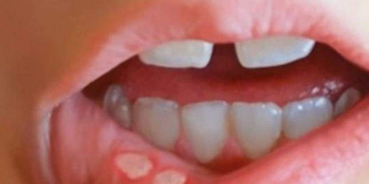 O uso de sal ou vinagre diretamente na lesão pode irritar ainda mais a região e retardar a cicatrização