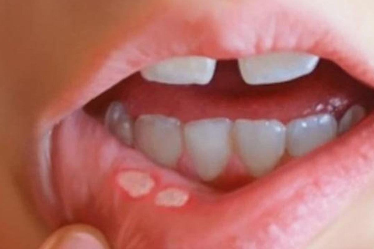 O uso de sal ou vinagre diretamente na lesão pode irritar ainda mais a região e retardar a cicatrização