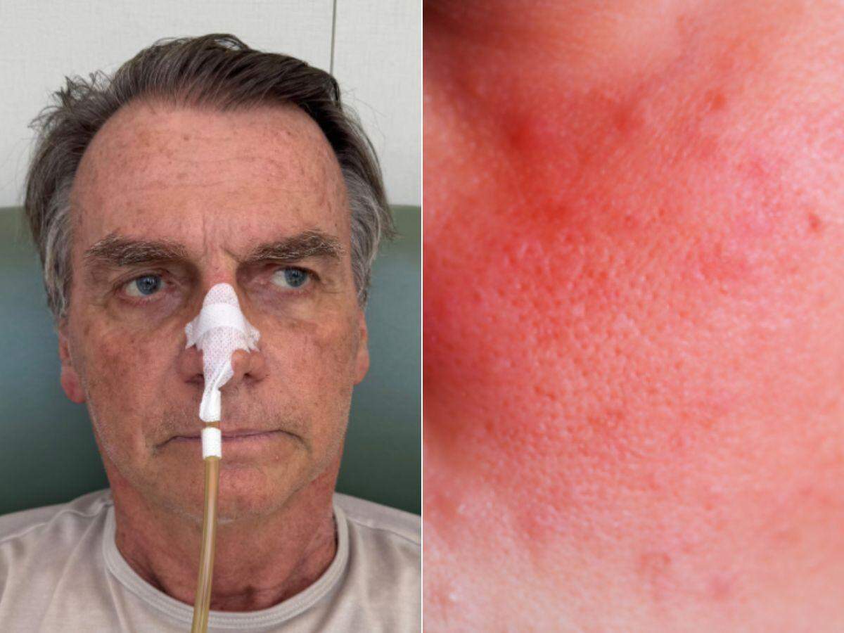 Câncer de pele de Bolsonaro: como identificar o carcinoma de células escamosas, tratar e prevenir o tumor