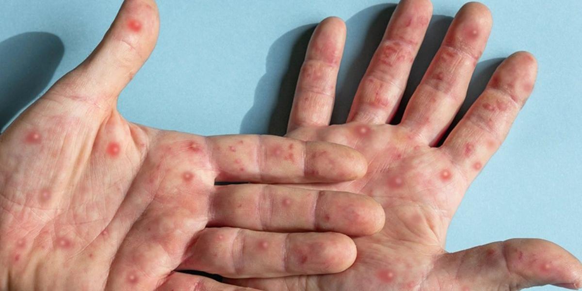 Doença é causada pelo mpox vírus e, entre seus sintomas, estão as erupções cutâneas ou lesões de pele