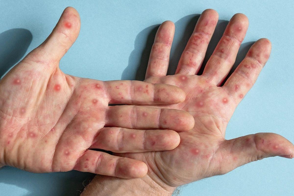 Doença é causada pelo mpox vírus e, entre seus sintomas, estão as erupções cutâneas ou lesões de pele
