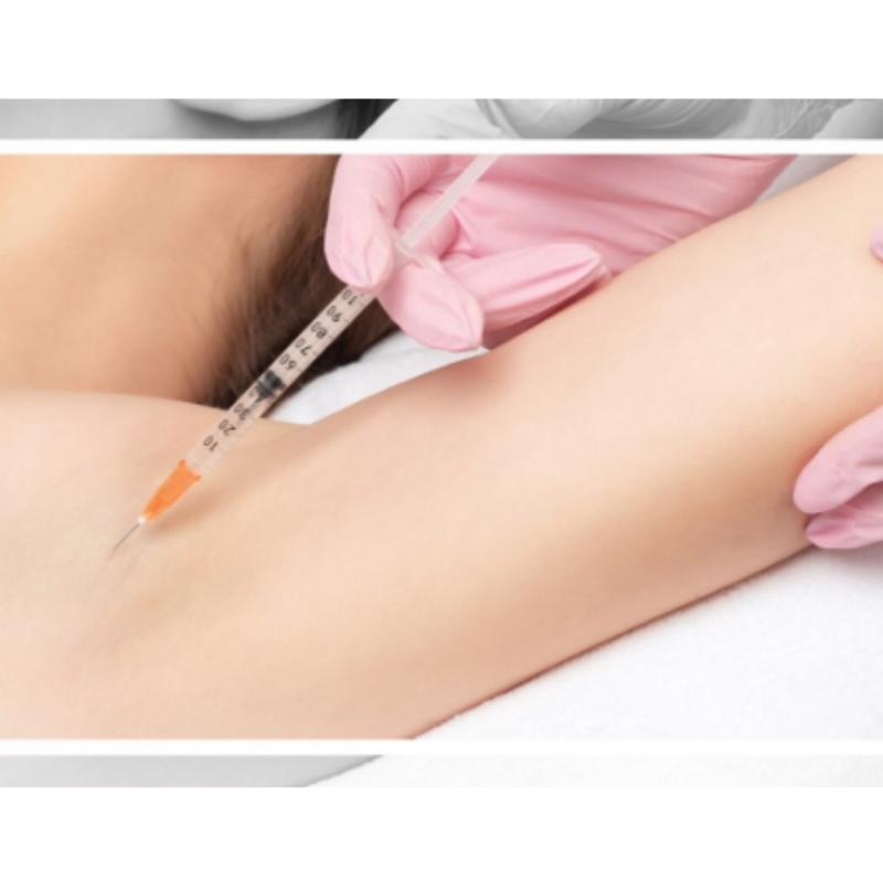 Aplicada em axilas e mãos, a toxina botulínica reduz a transpiração e o odor por alguns meses