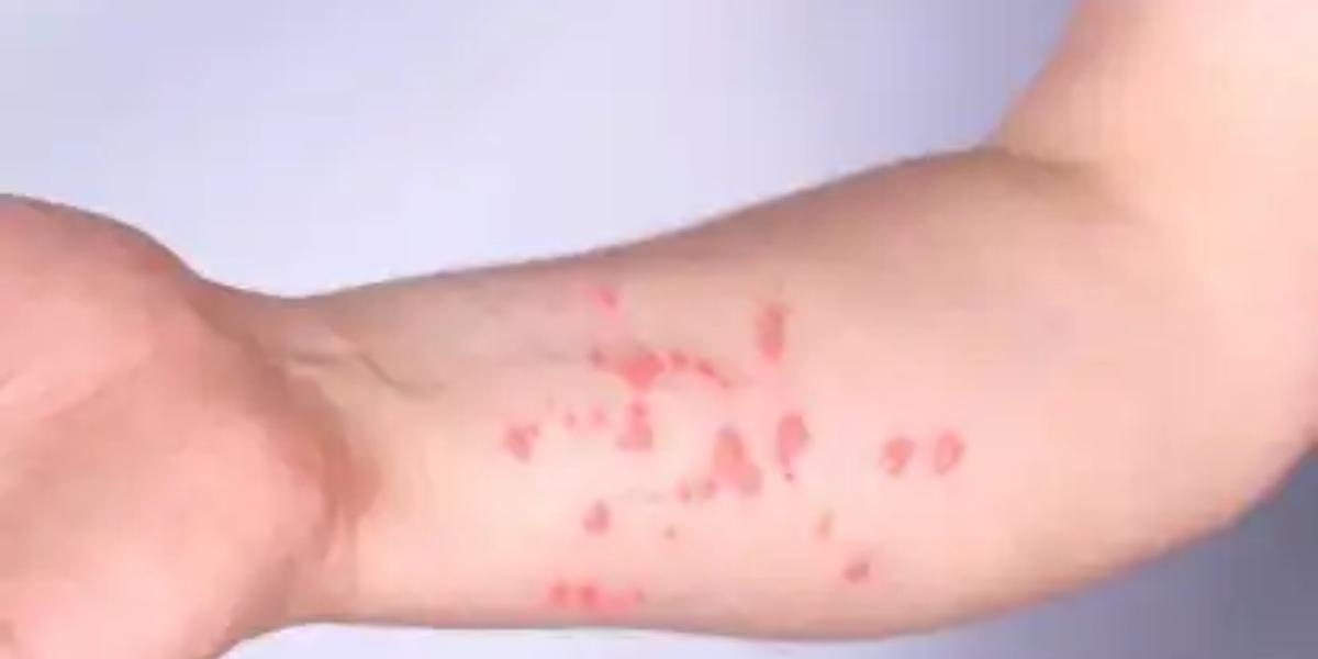  Mpox: como reconhecer os principais sinais e sintomas da doença