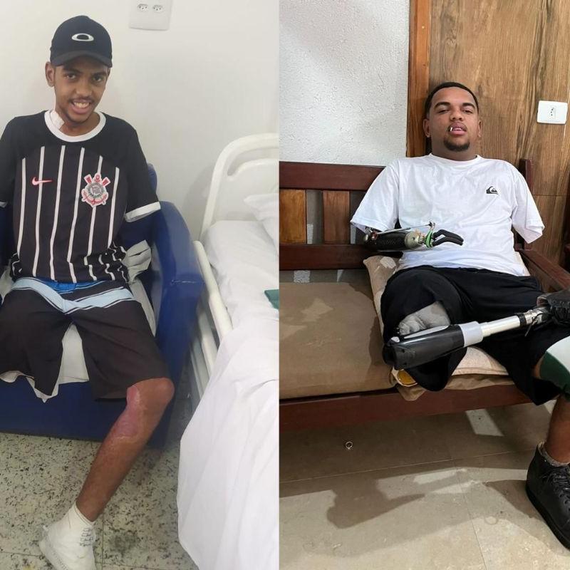 Jovem que perdeu membros após descarga elétrica luta para conseguir prótese