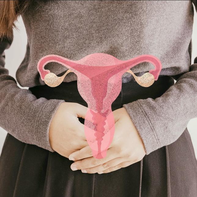 A endometriose é caracterizada pelo crescimento do tecido endometrial fora da cavidade uterina
