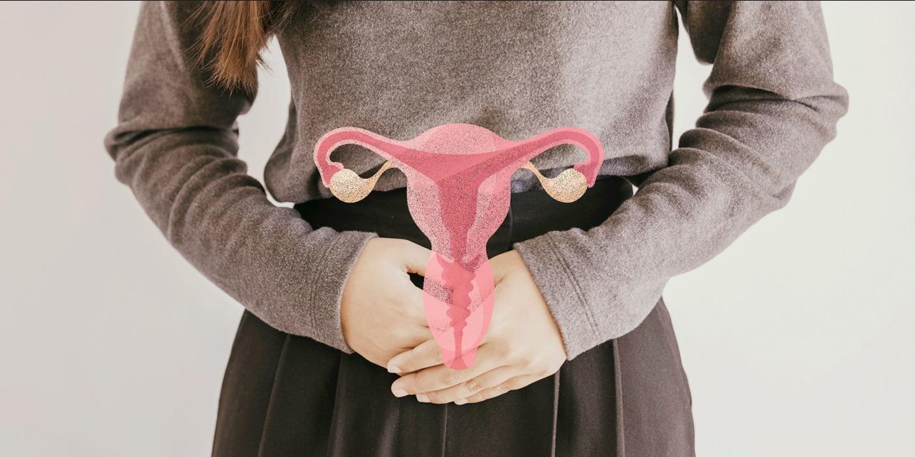A endometriose é caracterizada pelo crescimento do tecido endometrial fora da cavidade uterina
