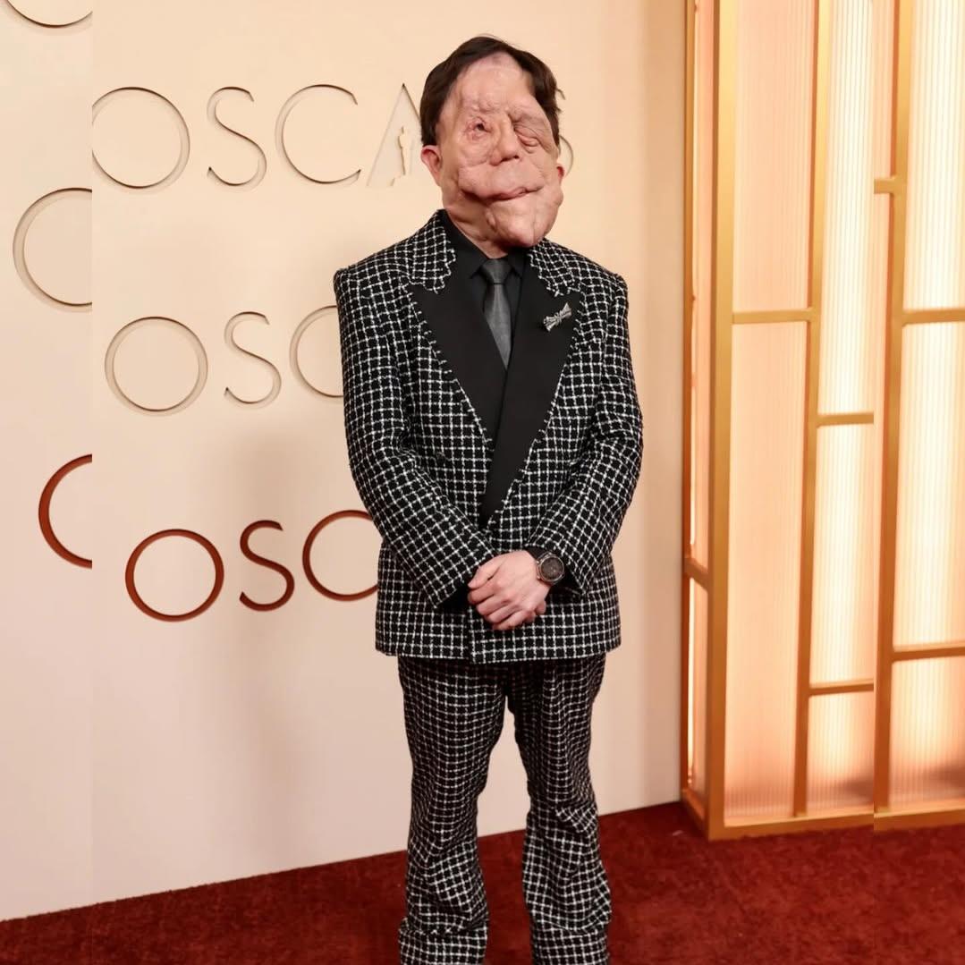 O ator britânico Adam Pearson, de 41 anos, chamou atenção ao passar pelo tapete vermelho da cerimônia do Oscar, há duas semanas. O artista convive com uma forma de neurofibromatose