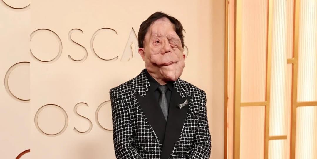 O ator britânico Adam Pearson, de 41 anos, chamou atenção ao passar pelo tapete vermelho da cerimônia do Oscar, há duas semanas. O artista convive com uma forma de neurofibromatose