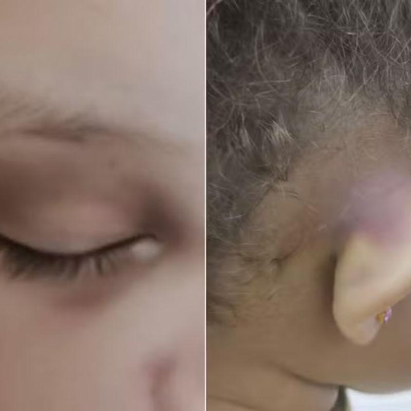 Olhos inchados e orelha  com machucados foram constatados pelo pai da menina
