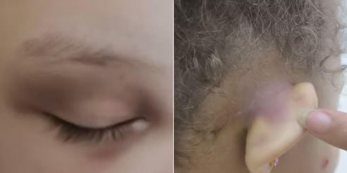 Olhos inchados e orelha  com machucados foram constatados pelo pai da menina