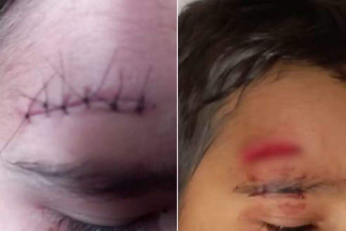 Menino teve um corte na testa e precisou levar pontos