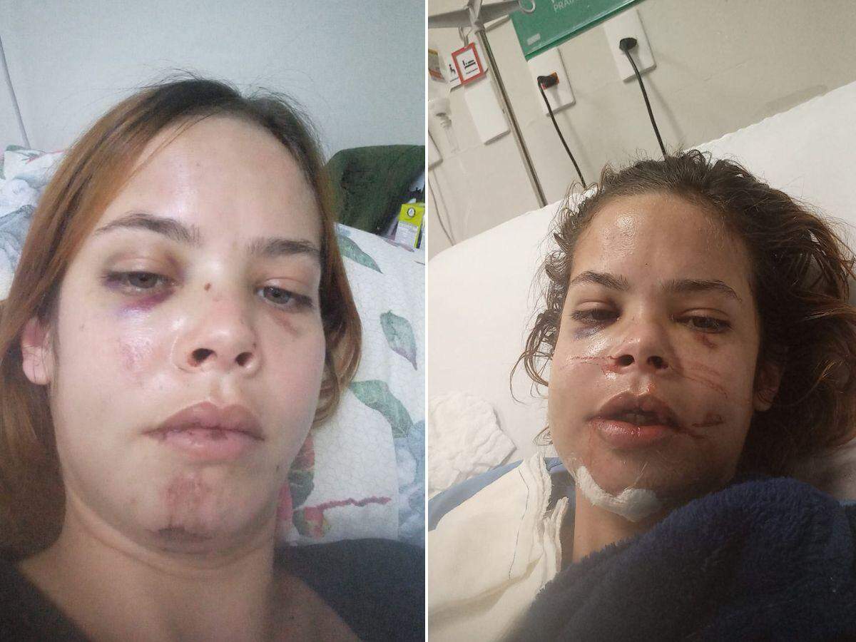 Gabriela passou por uma cirurgia de oito horas após o acidente