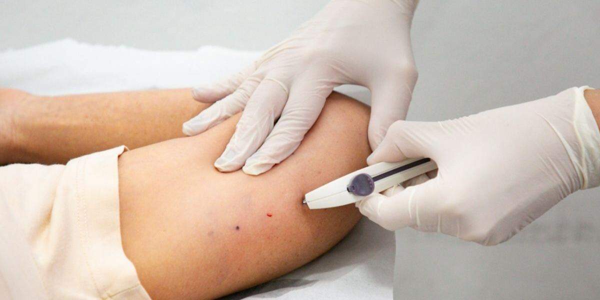 Cidade faz implantes de Implanon, remédio para prevenir gravidez. Foco: evitar gestações na adolescência