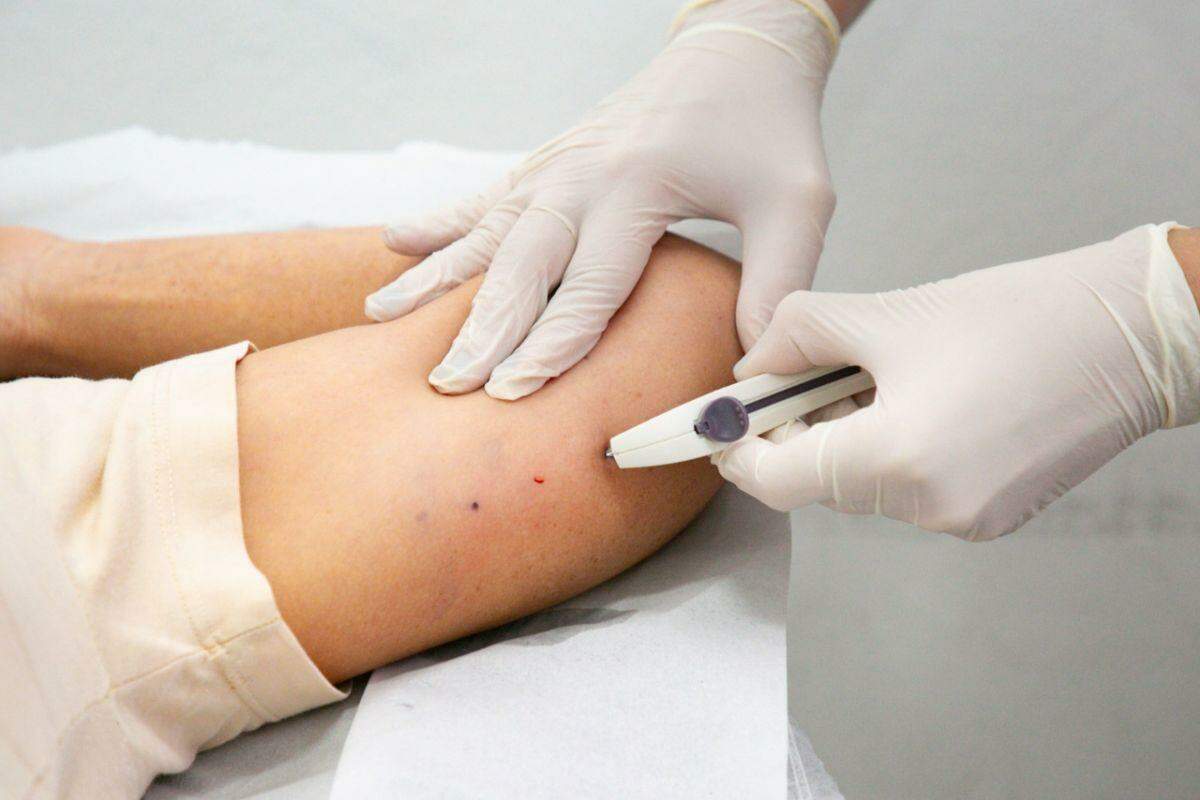 Cidade faz implantes de Implanon, remédio para prevenir gravidez. Foco: evitar gestações na adolescência