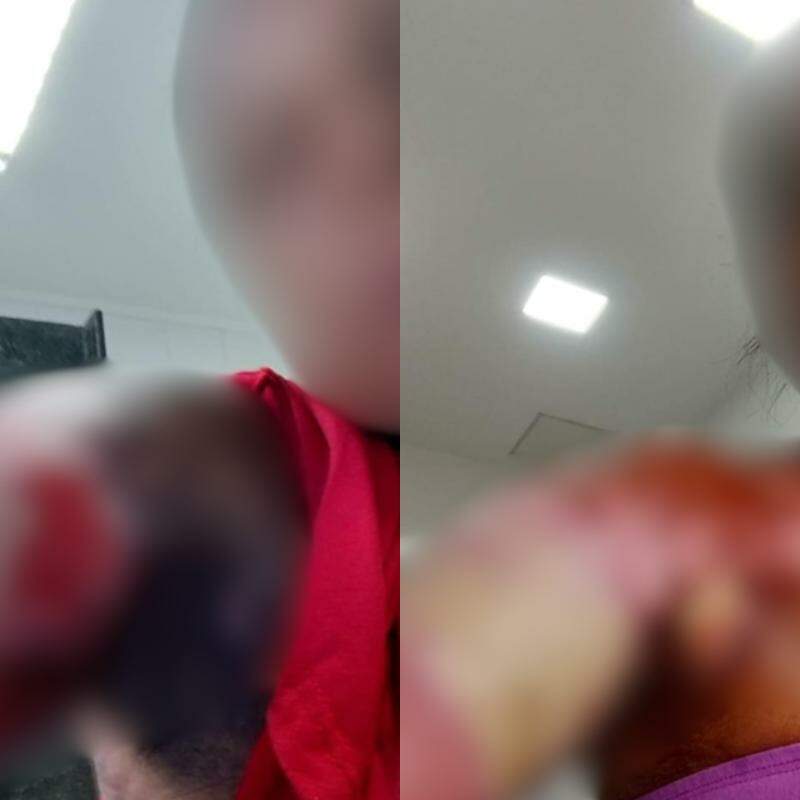 A mulher sofreu queimaduras de 1º e 2º graus