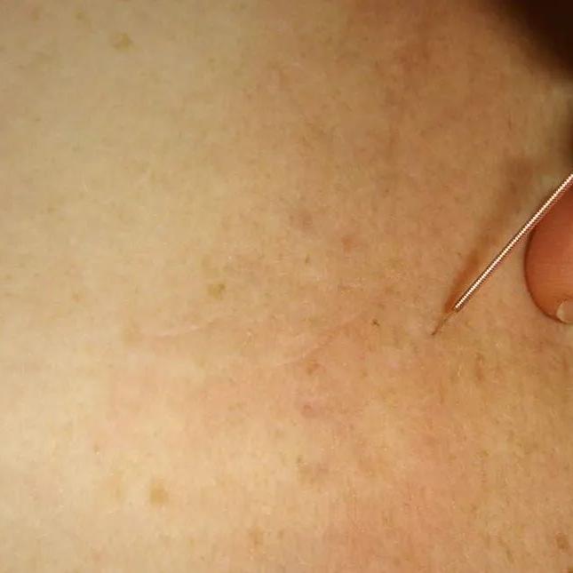  Mulher procurou a massoterapeuta após sentir dores no pescoço 