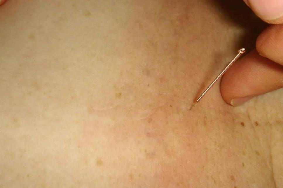  Mulher procurou a massoterapeuta após sentir dores no pescoço 