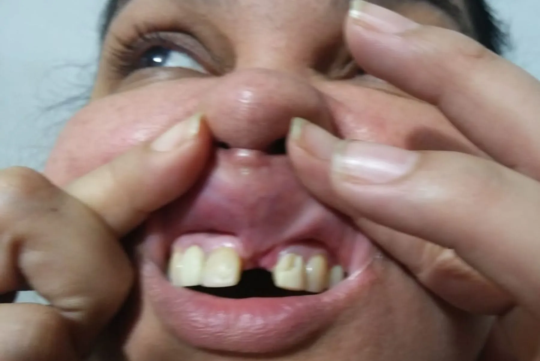 Andressa perdeu dois dentes e teve o freio labial cortado e costurado errado