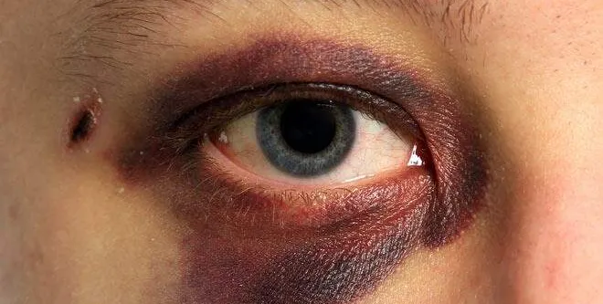  Mulher ficou com o olho roxo após receber soco do marido 