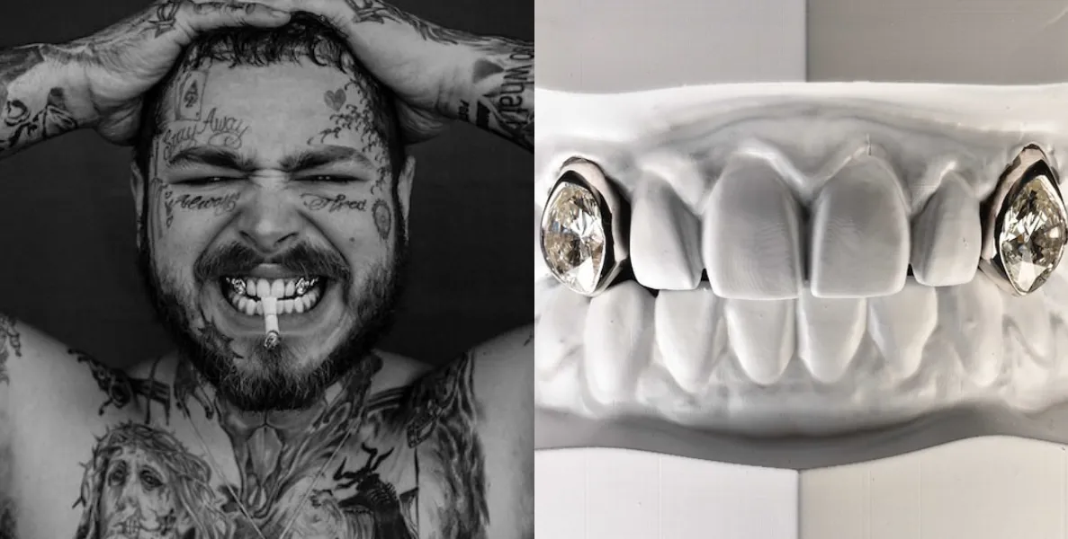   Post Malone realizou implante dentário de diamantes  