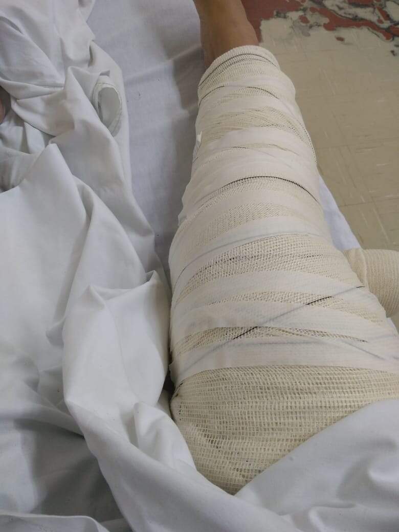 Vítima teve ferimentos na perna e o joelho fraturado após passar por desnível na pista 