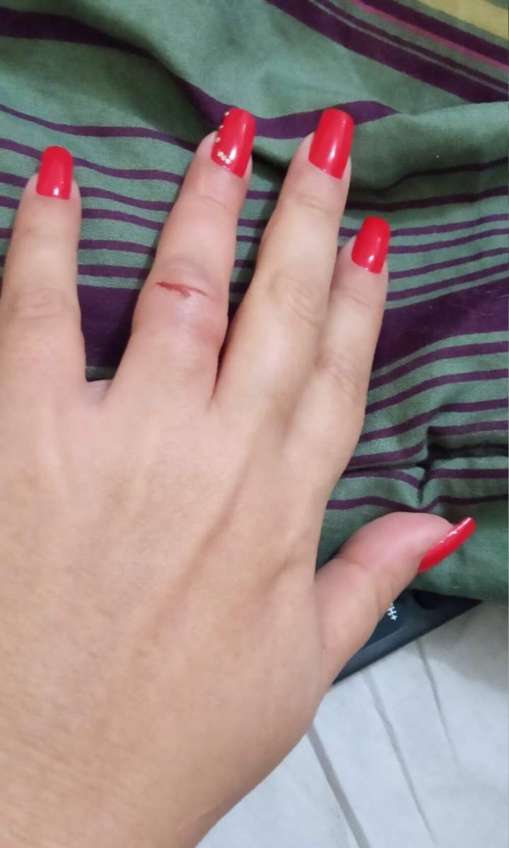 Vítima ficou com o dedo machucado após ter sido mordida por bandido 