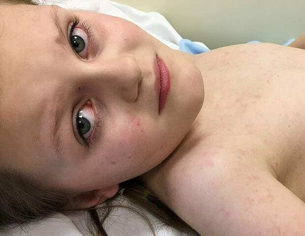 Millie apresentou manchas pelo corpo, vômitos e febre de quase 40°C 