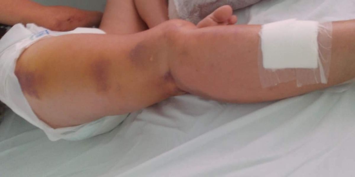 Paciente fraturou o colo do fêmur em acidente de moto no dia 20 de janeiro