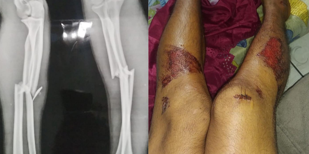 Kauã, de 16 anos, sofreu duas fraturas no braço e escoriações pelo corpo